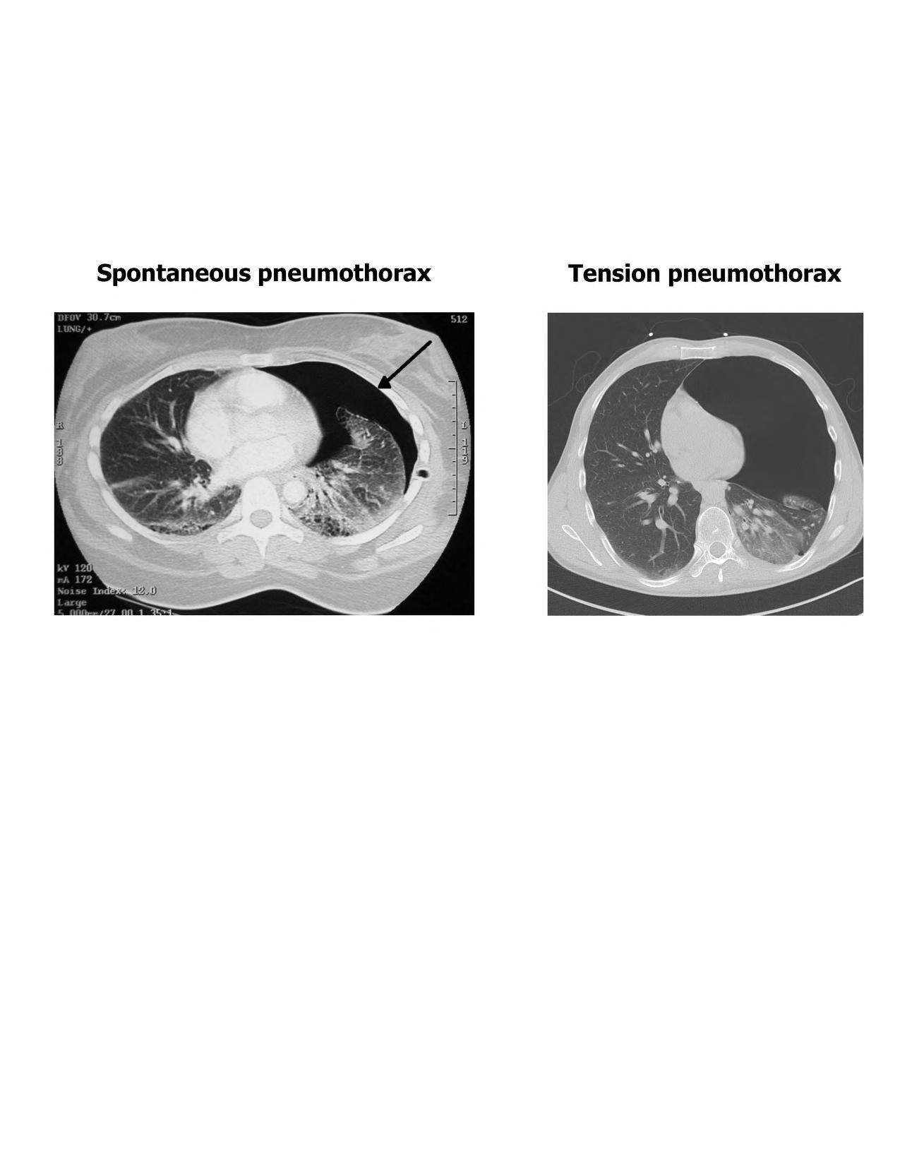 CT comparison of an uncomplicated pneumothorax and a tension pneumothorax :  Kindred Grey : Free Download, Borrow, and Streaming : Internet Archive